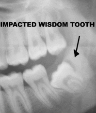wisdom-teeth