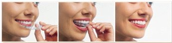 Image result for invisalign pictures